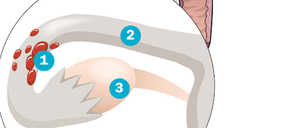 Endometrioseherde (1), also chronische, gutartige Wucherungen von Gebärmutterschleimhaut, finden sich meist im Bereich des Beckens, sehr häufig in den Eileitern (2) oder Eierstöcken (3).