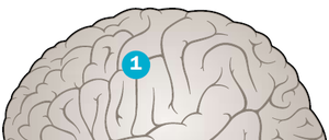 Bei einem epileptischen Anfall entladen sich in der Hirnrinde (1) massiv synchron Neuronengruppen. Ist die gesamte Hirnrinde davon betroffen, spricht man von einem generalisierten Anfall, sind es nur einzelne Stellen, von einem Fokal-Anfall.