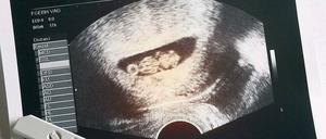 Der Test mit Ultraschall (Sonografie) kommt während der Schwangerschaft dreimal zum Einsatz: im 3., 6. und 8. Monat. 
