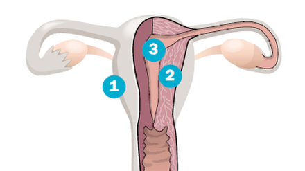 Die Gebärmutter (Uterus) (1) ist ein birnenförmiges, rund sieben bis neun Zentimeter langes und fünf Zentimeter breites Hohlorgan. Der Gebärmutterkörper (2) besteht aus muskulösem Gewebe, das innen - in der Gebärmutterhöhle (3) - mit einer Schleimhaut ausgekleidet ist. In diese nistet sich eine befruchtete Eizelle ein..