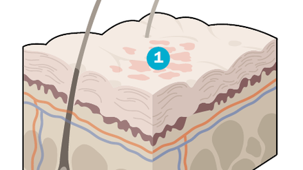 Bei einer Schuppenflechte ist die Zellentwicklung in der Oberhaut (1) gestört. Dadurch entstehen mehr oder weniger dicke schuppige, oft juckende Stellen. Besonders häufig treten diese am Ellenbogen, an den Knien, entlang der Lendenwirbelsäule, am Kopf und an den Fingernägeln auf.