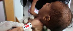 Ein unterernährtes Baby in Jemen. Der Anteil an unterernährten Menschen steigt von Jahr zu Jahr.