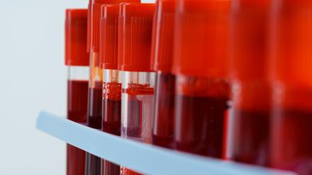 Mithilfe von Blutanalysen sollen Nährstoffmängel frühzeitig ausfindig gemacht werden.