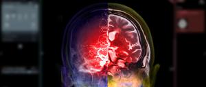 CTA brain and mri brain fusion image