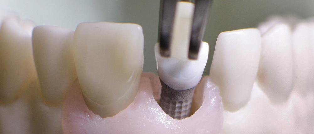 Ein Zahnimplantat wird in ein Unterkiefermodell eingesetzt