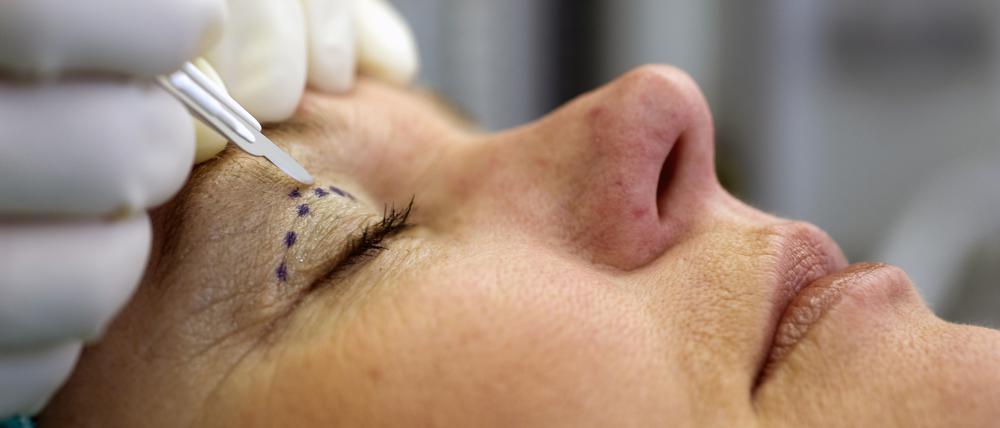 Ein Schönheitschirurg setzt das Skalpell am Augenlid einer Patientin an. 