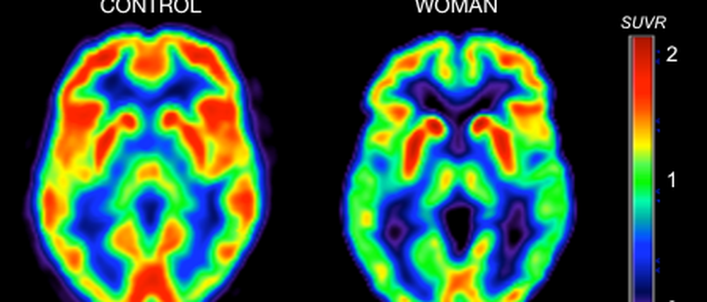 Vor der Menopause (links) ist die Hirnaktivität im Scan noch normal, danach (rechts) ist der Energielevel des Denkorgans um bis zu 30 Prozent reduziert. Womöglich ein Faktor, der bei Frauen Alzheimer mit auslösen könnte.   