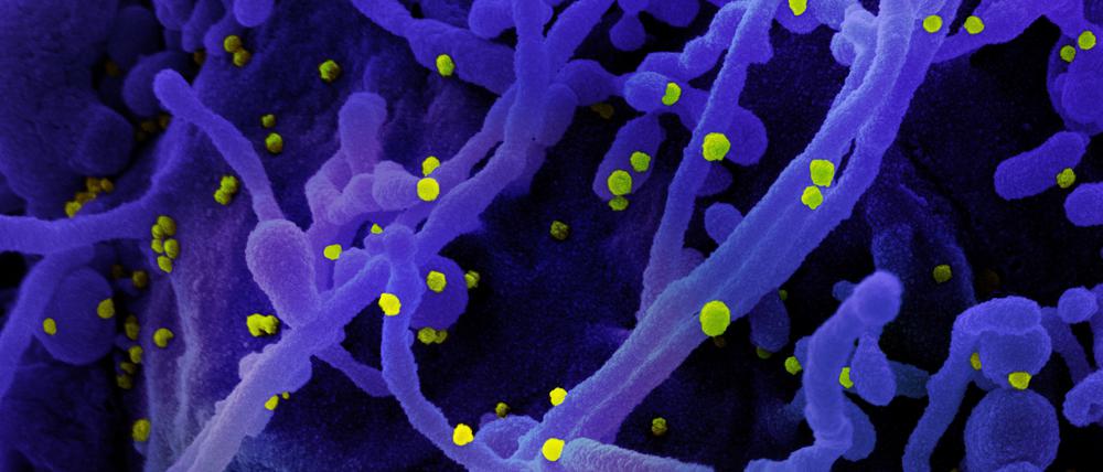 Sars-CoV-2-Viruspartikel (gelb) werden von einer infizierten Zelle (blau) abgeschnürt und befallen neue Zellen.