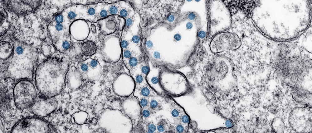 Sars-CoV-2-Viren (blau) sehen im Transmissionselektronenmikroskop heute noch so aus wie beim ersten Covid-19-Patienten in den USA. Doch das Erbgut der Erreger im Inneren der Virushülle verändert sich stetig. 